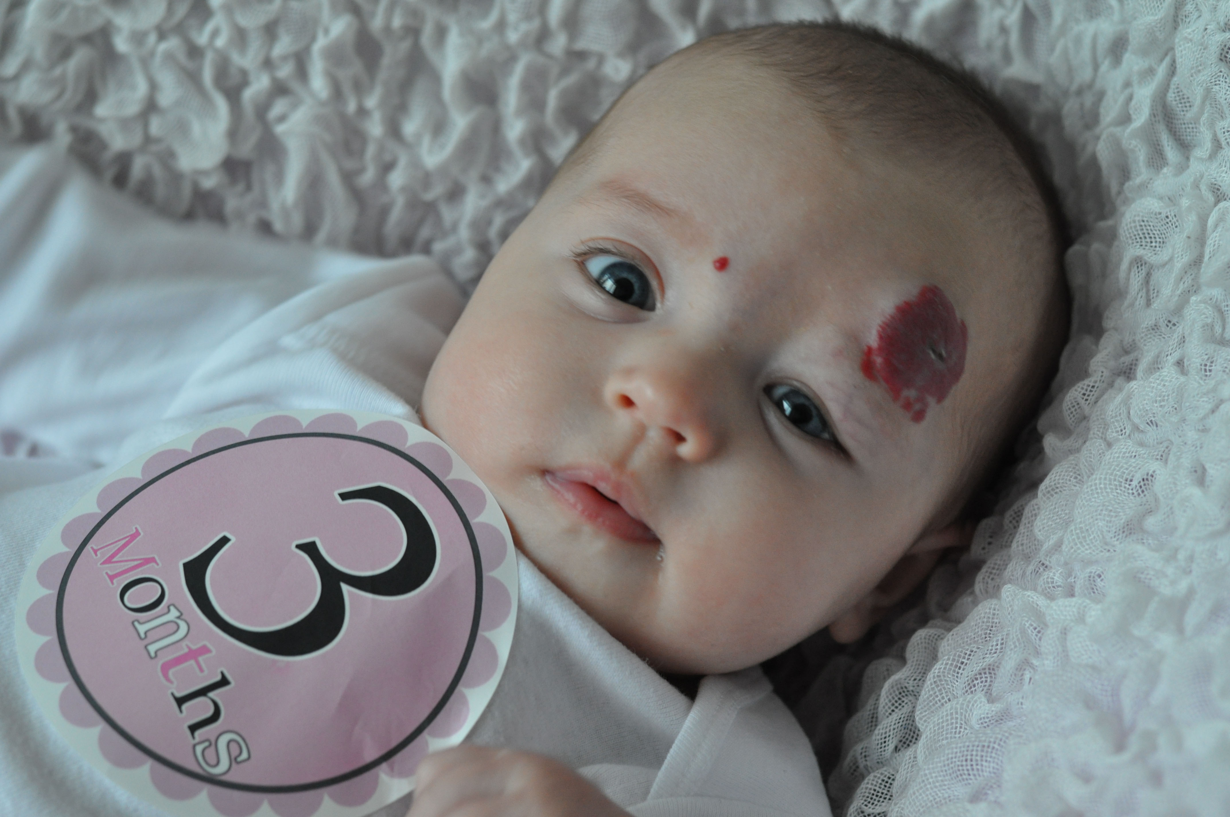 What is a stork bite birthmark on a baby? - Skin Care ...